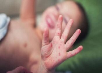 गोवरच्या मुळ आणखी एका बालकाचा मृत्यू – गोवर झालेल्या मृतांची संख्या 15