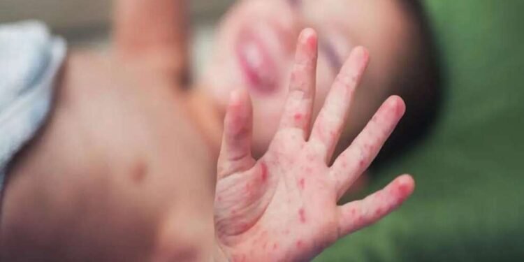 गोवरच्या मुळ आणखी एका बालकाचा मृत्यू – गोवर झालेल्या मृतांची संख्या 15