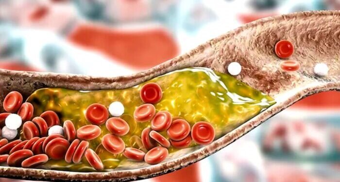 कोलेस्ट्रॉल वाढल्याची लक्षणे आणि उपचार पद्धती