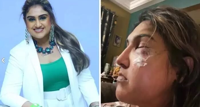 डोळ्यावर जखमा, चेहरा सुजला… अभिनेत्रीवर अज्ञाताकडून भररस्त्यात हल्ला, फोटो शेअर करत दिली माहिती