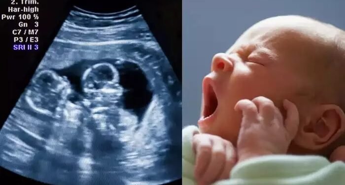 गर्भात जुळी, अल्ट्रासाऊंडमध्येही दिसली, पण जन्माला आलं एकच बाळ; रुग्णालयात खळबळ
